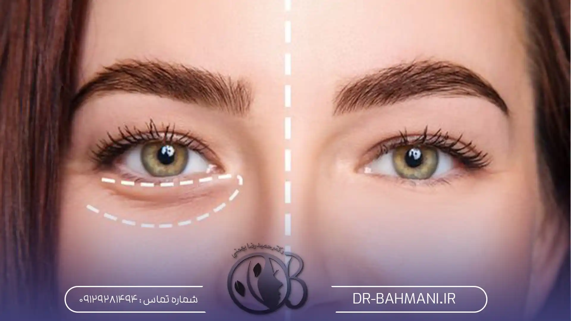 کربوکسی تراپی برای چشم