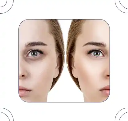 کربوکسی تراپی زیر چشم
