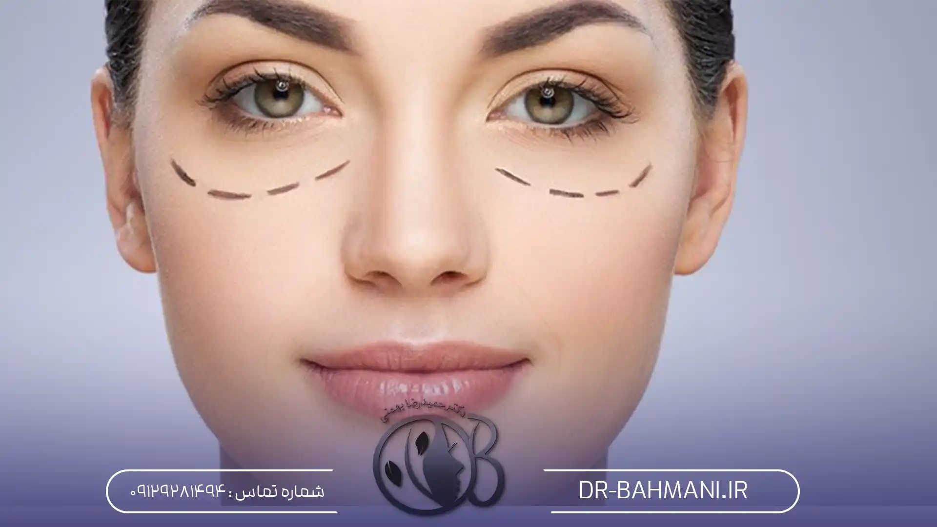 کربوکسی تراپی چشم