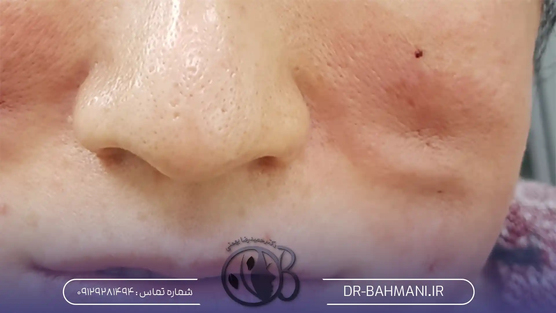 Side effects of thread facelift