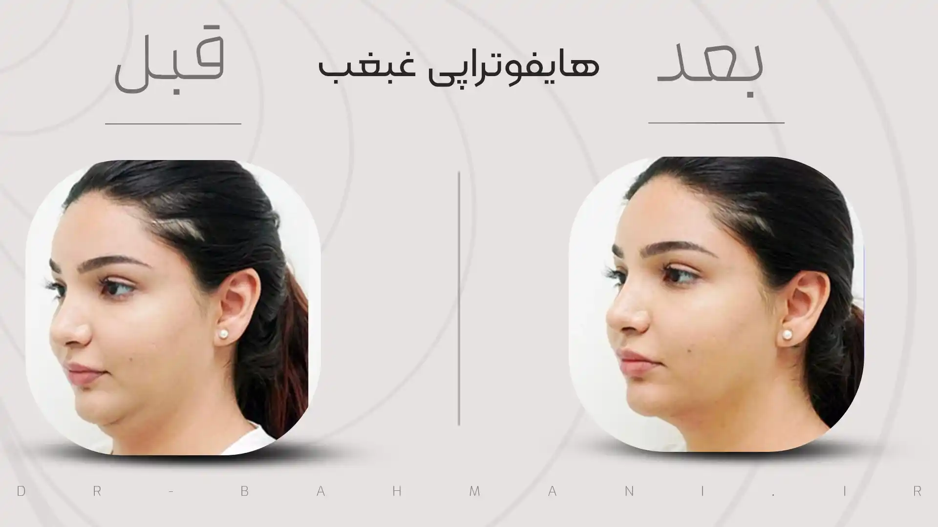 قبل و بعد هایفوتراپی غبغب