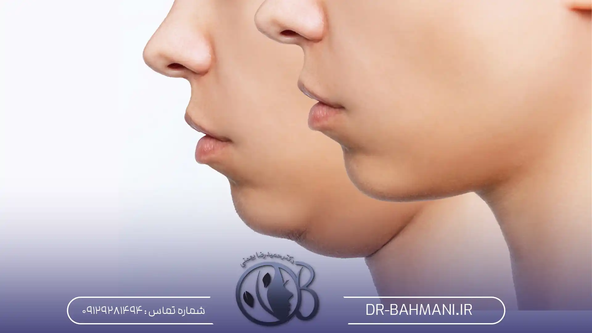 هایفوتراپی غبغب