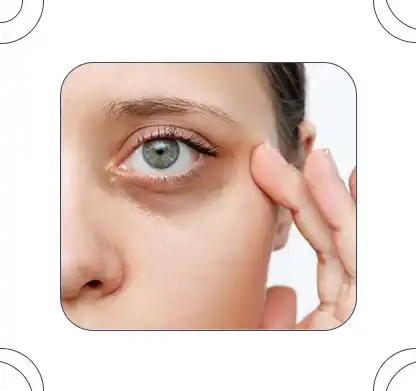 تیرگی زیر چشم