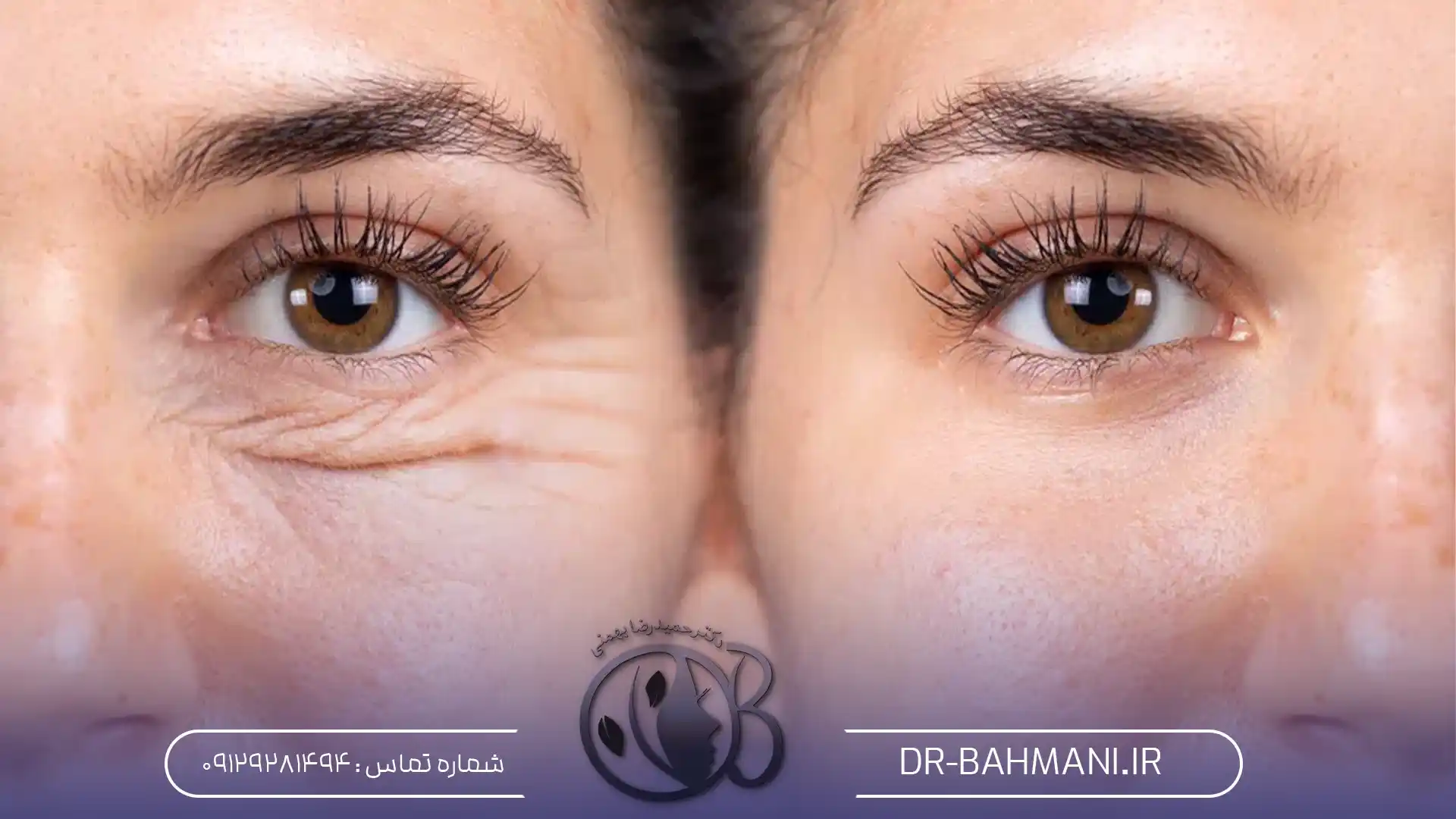 هزینه عمل بلفاروپلاستی