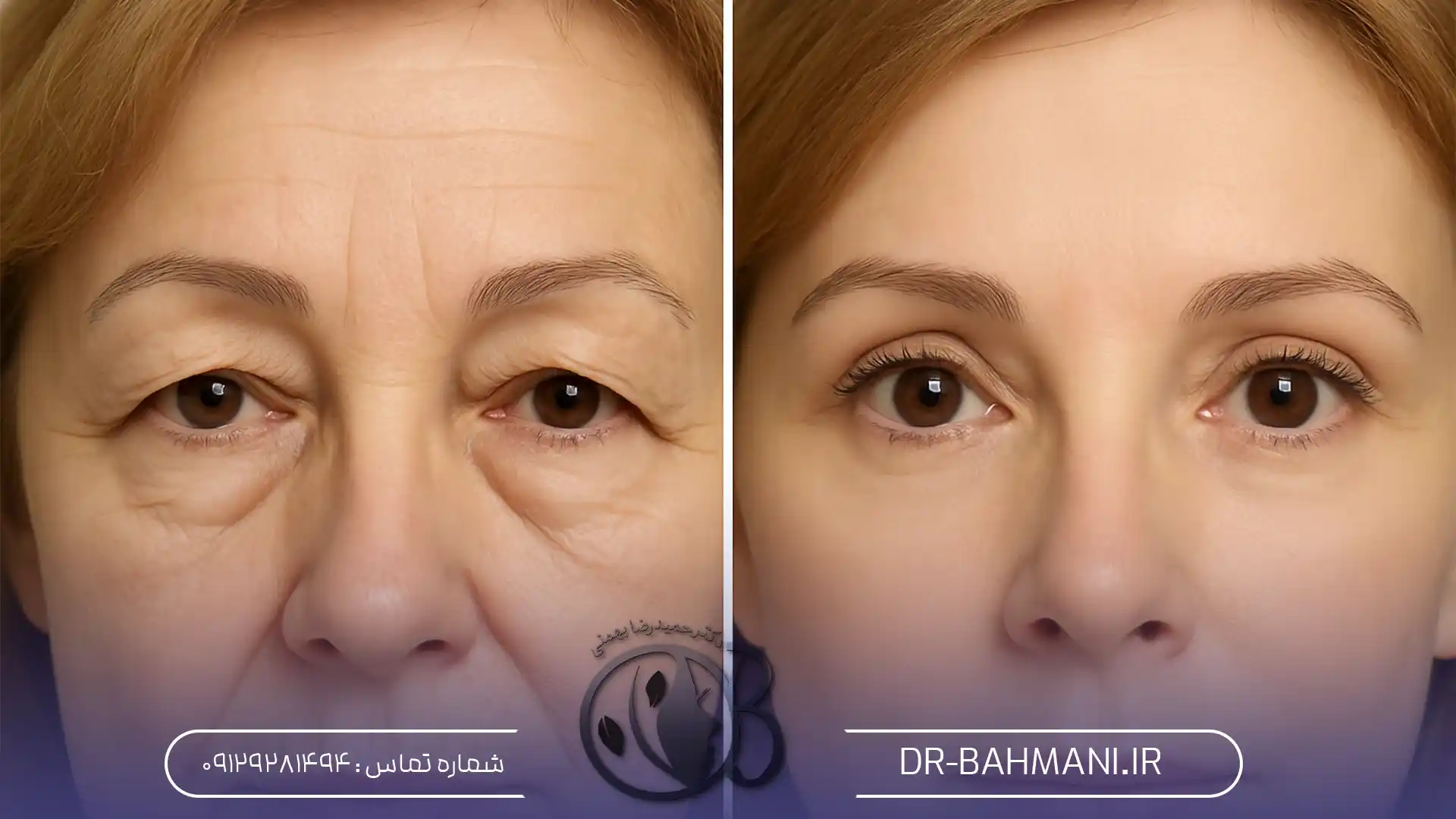 هزینه عمل جراحی پلک