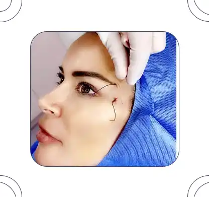 مزایا، معایب و هزینه لیفت چشم با نخ