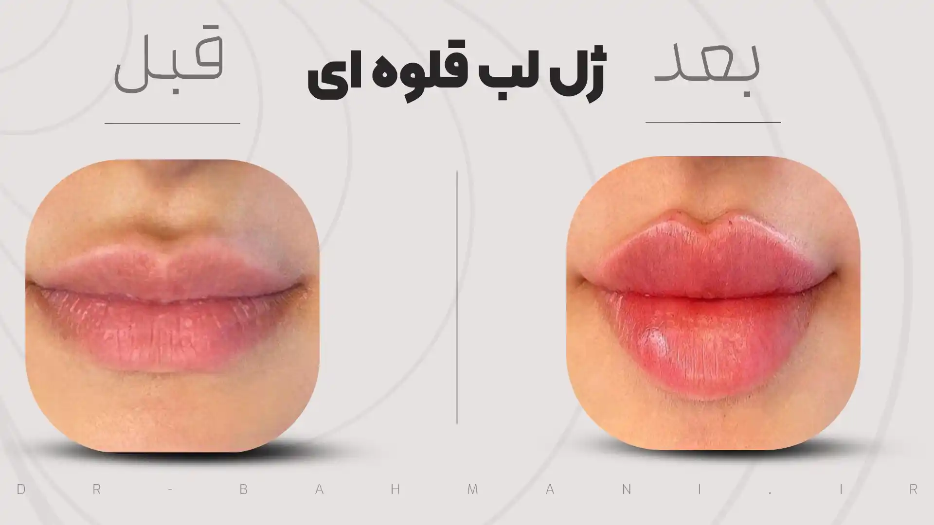تزریق ژل لب مدل قلوه ای