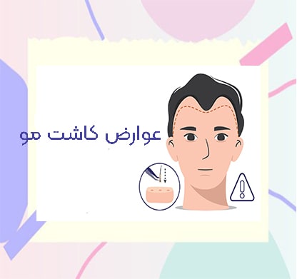 عوارض کاشت مو ،تصویر شاخص