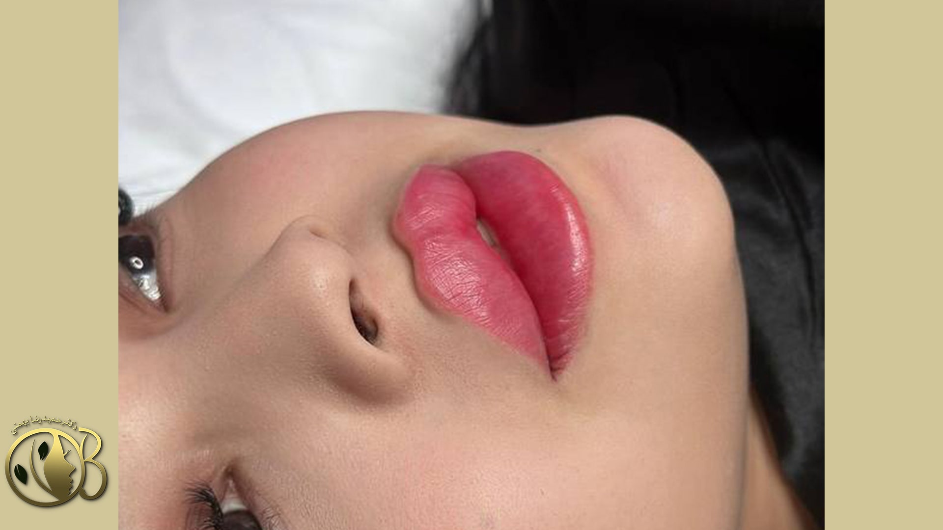 Advantages of three-button lip gel injection