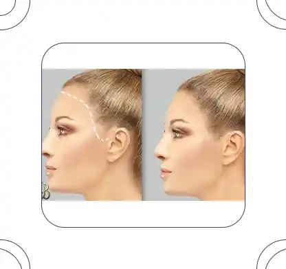 Hair transplant for women