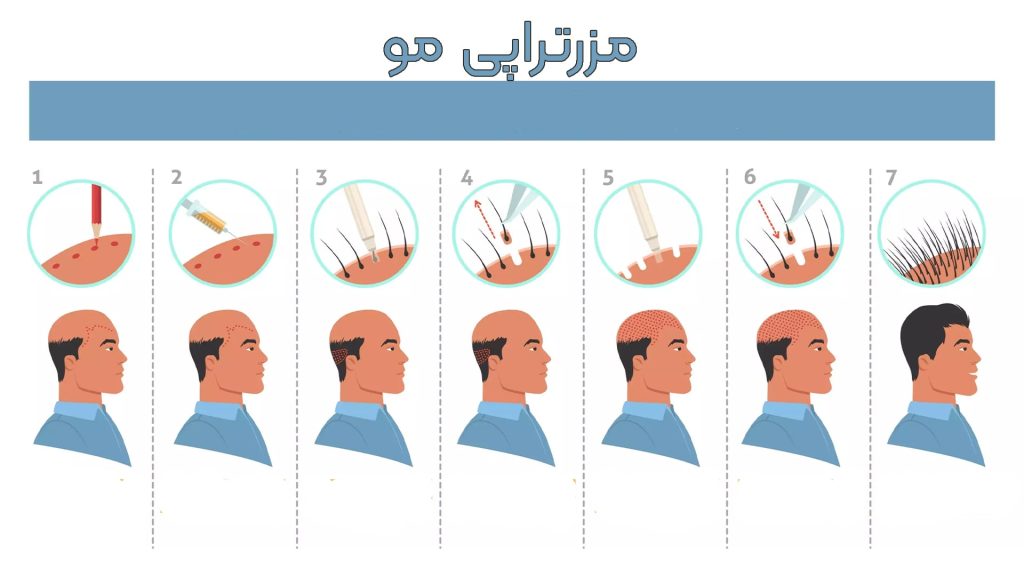 مزوتراپی مو