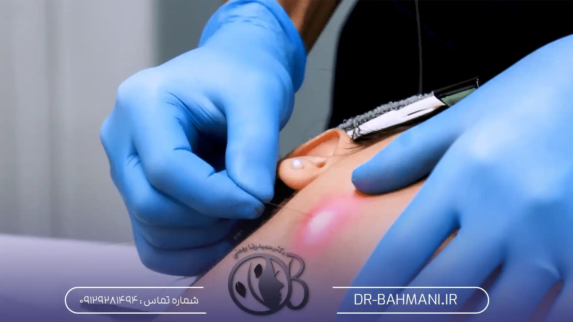 Endolift laser durability