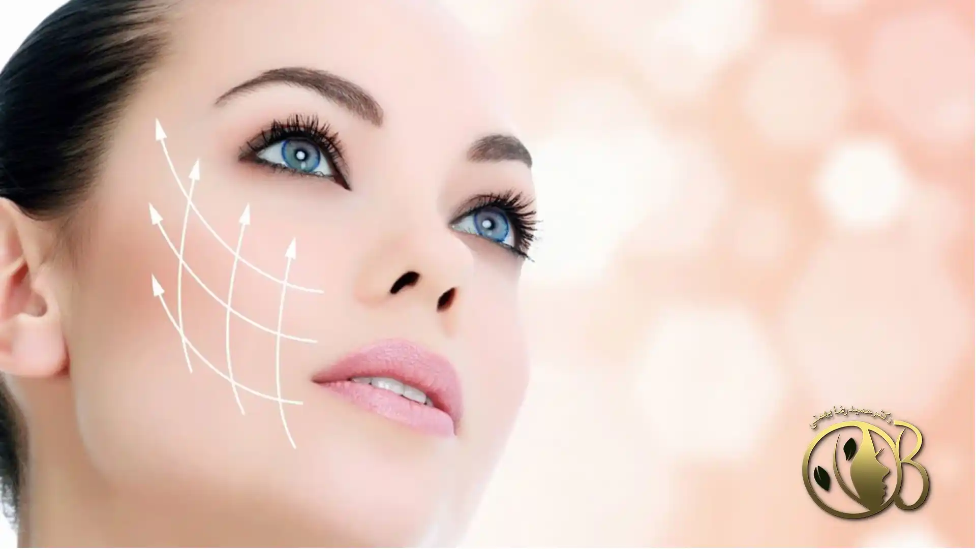 Forehead endolift laser
