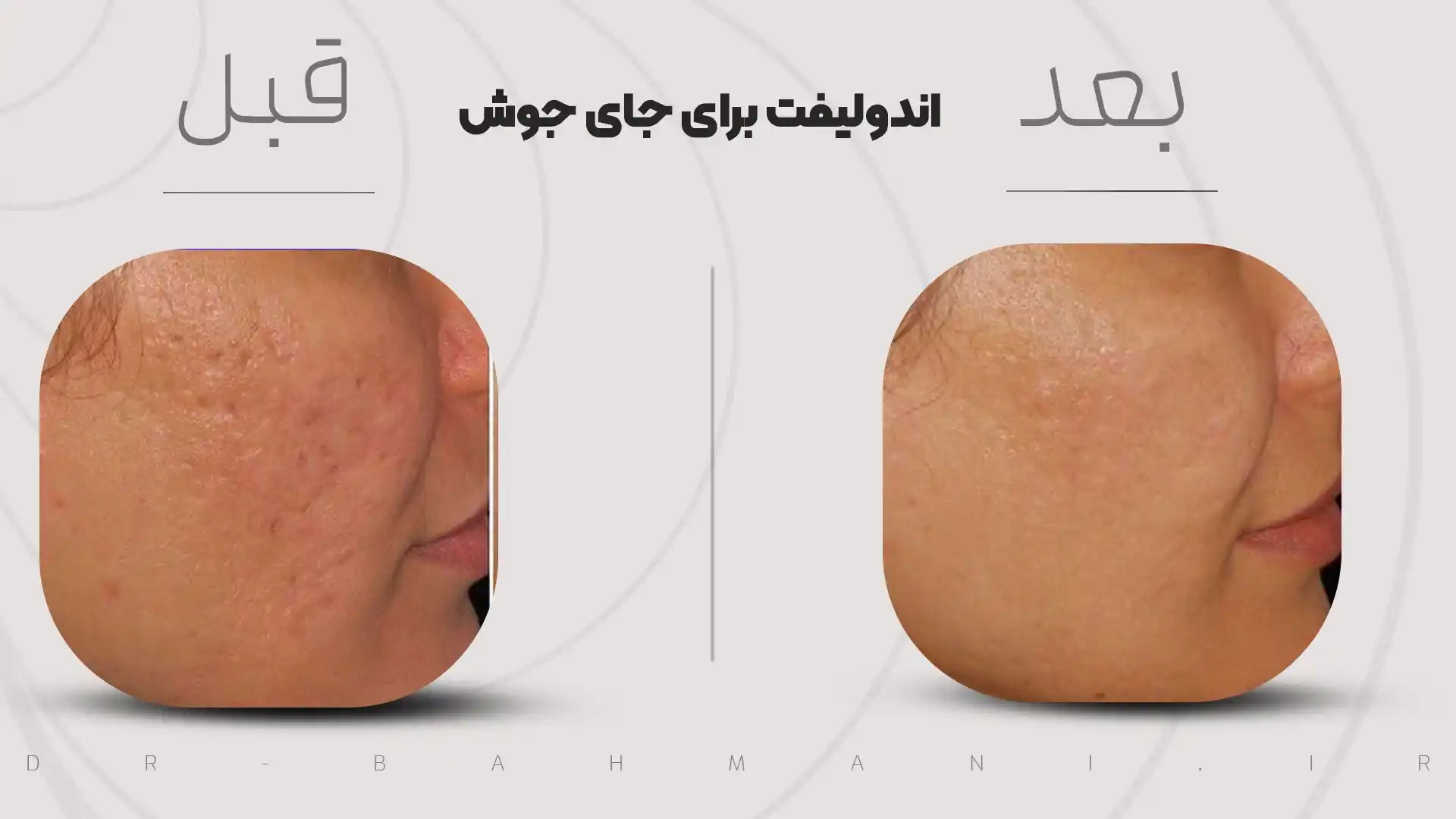 endolift acne