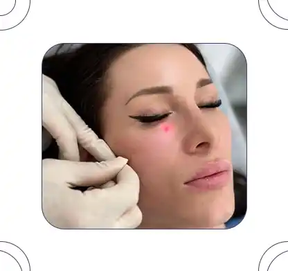 شاخص اندولیفت زیر چشم