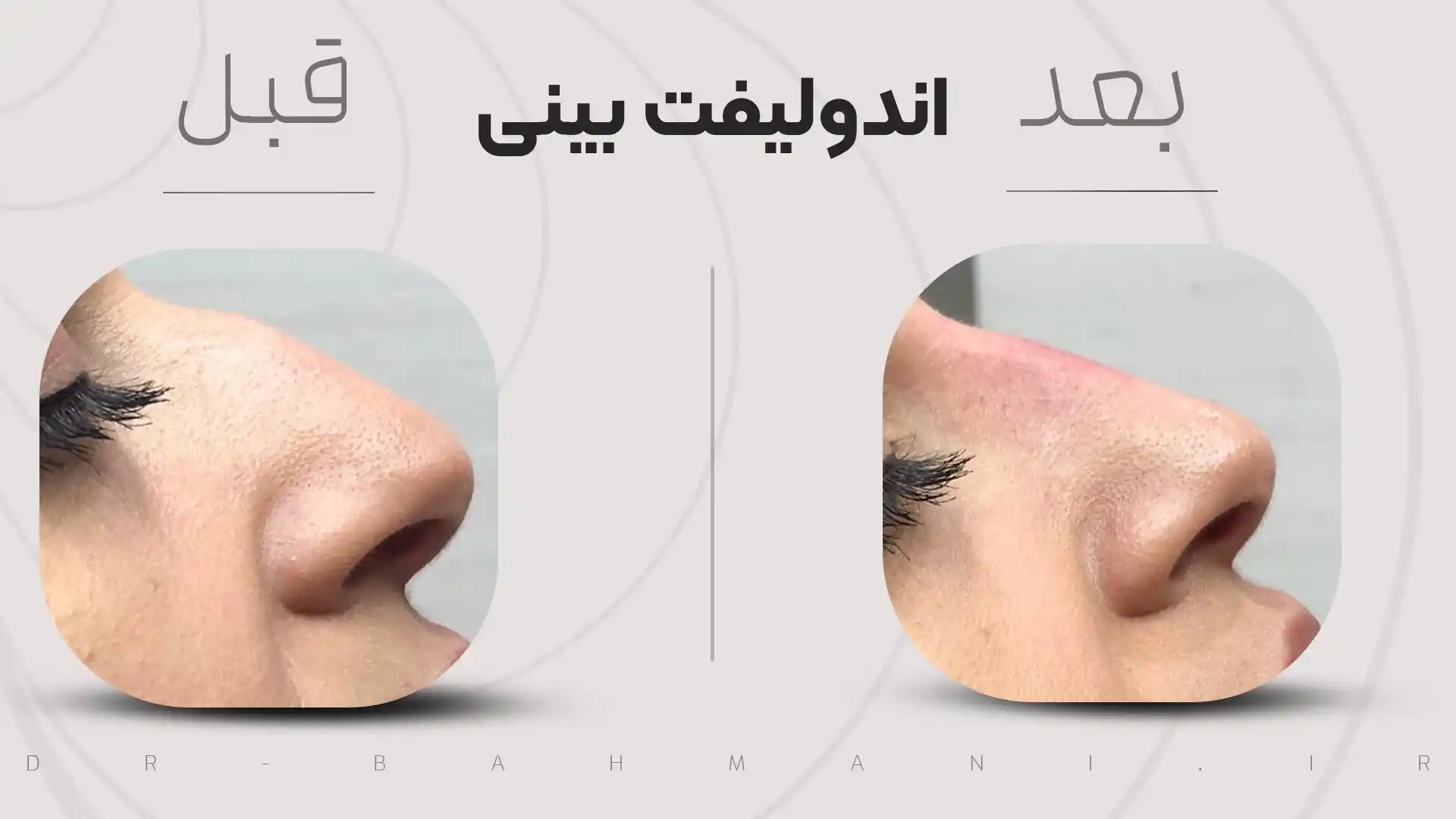 اندولیفت بینی