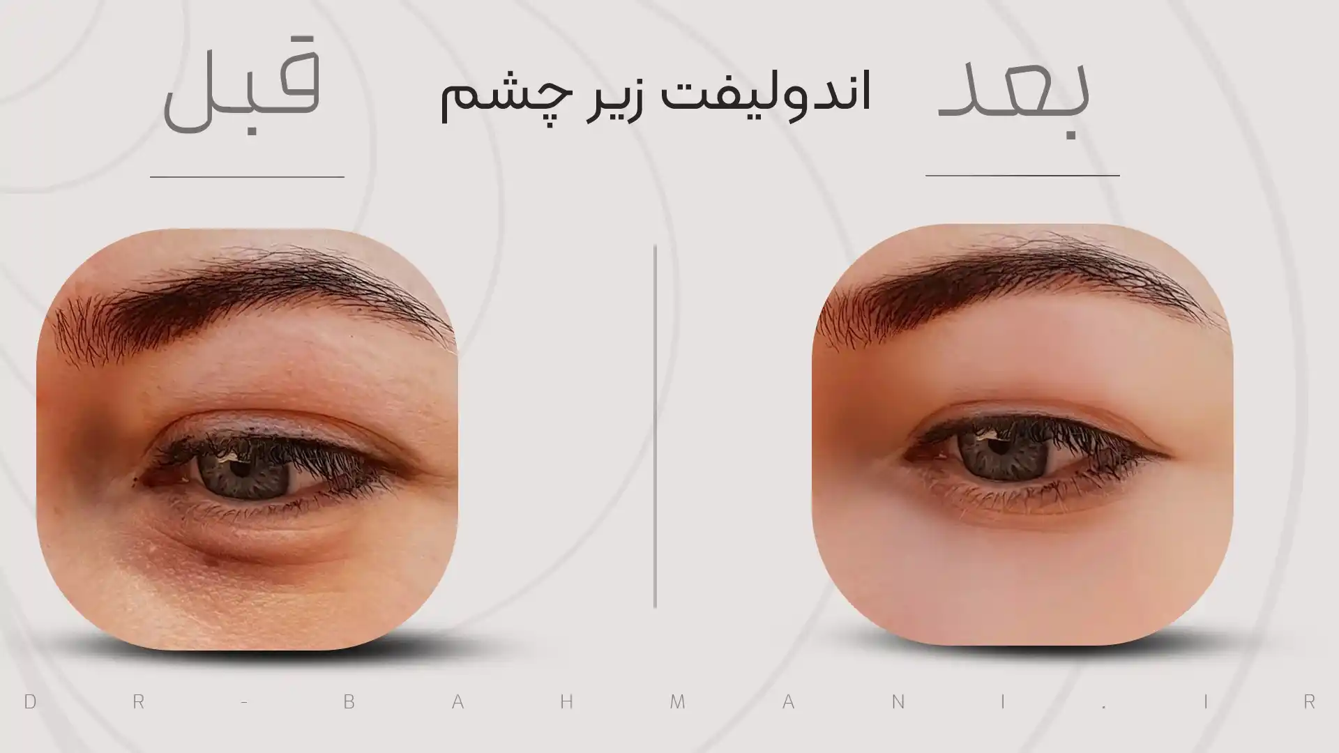 اندولیفت زیر چشم