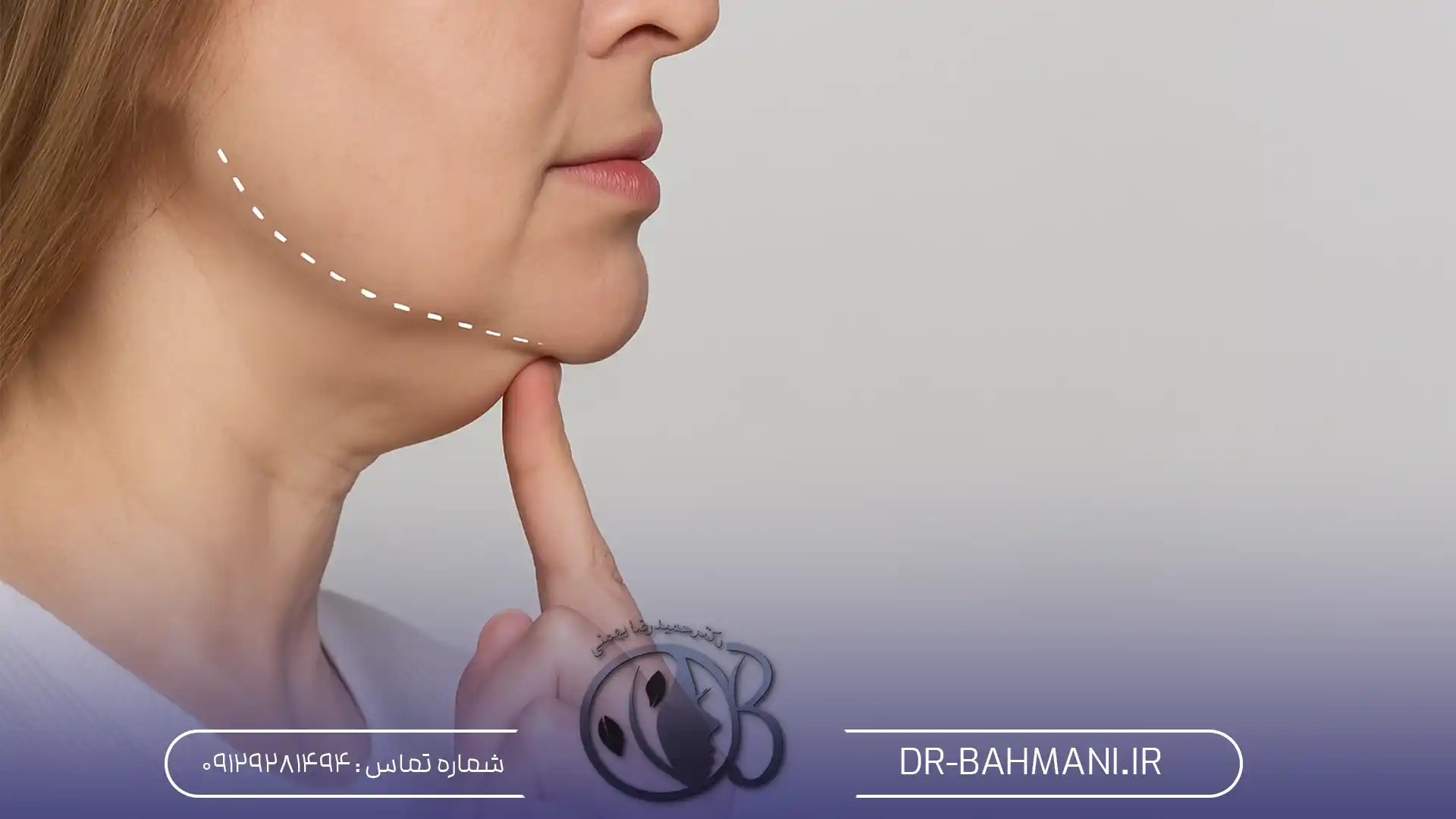 اندولیفت غبغب 1