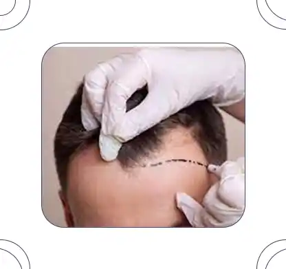 Swelling after hair transplant