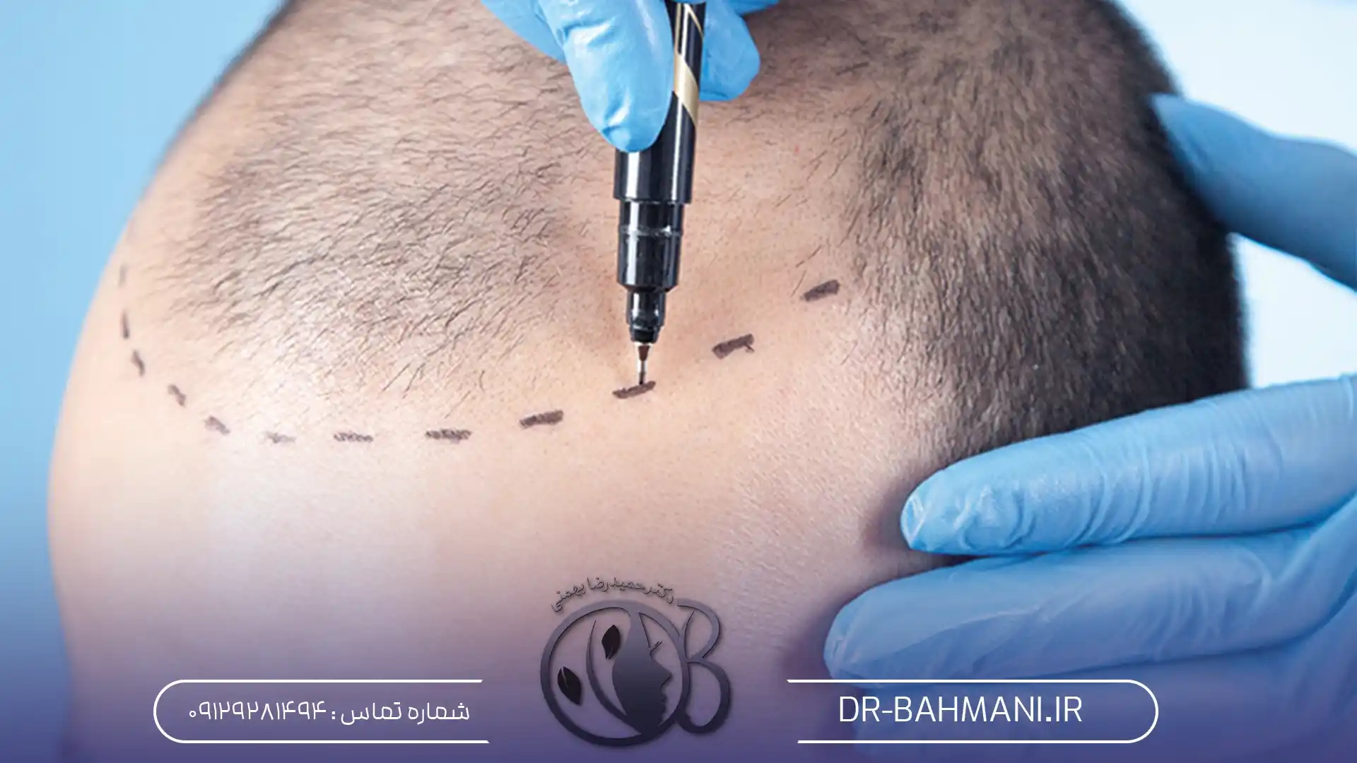 تورم بعد از کاشت مو