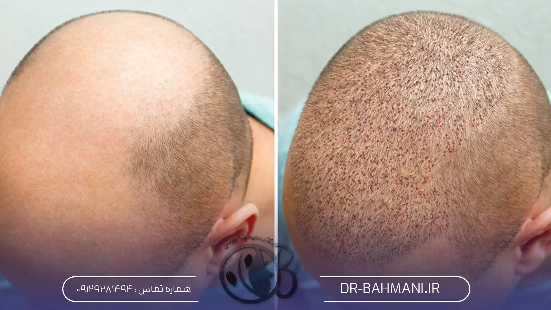 تورم پس از کاشت مو
