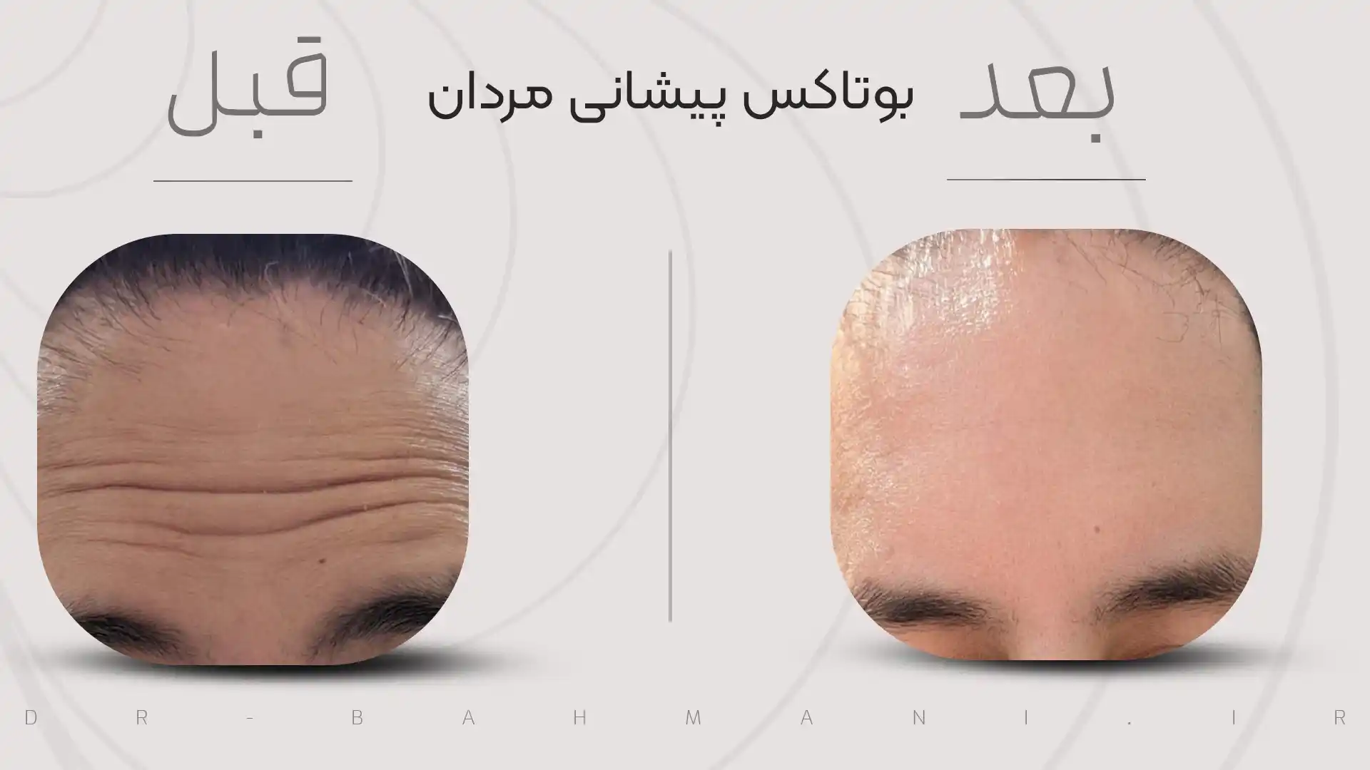 قبل و بعد از بوتاکس آقایان