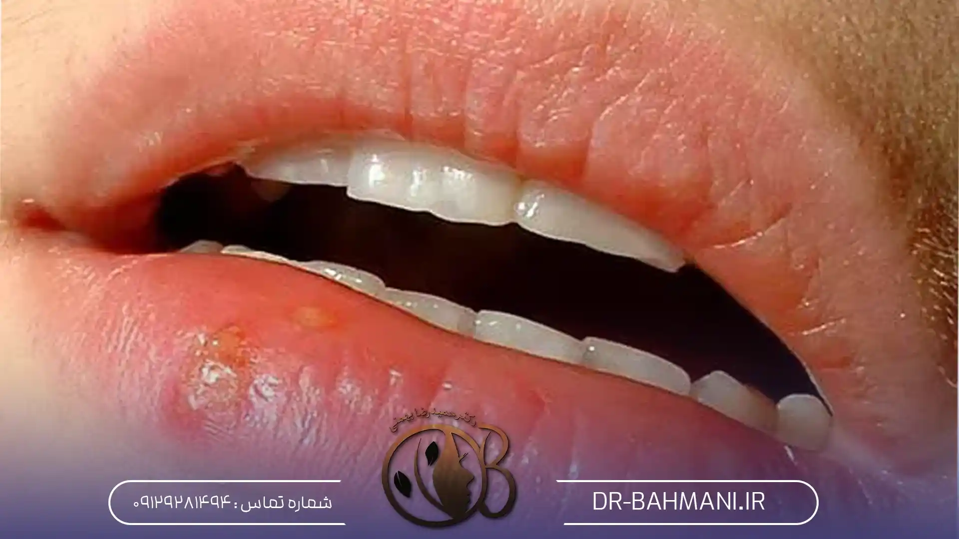 انواع تبخال