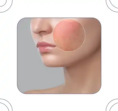 شاخص عوارض اندولیفت