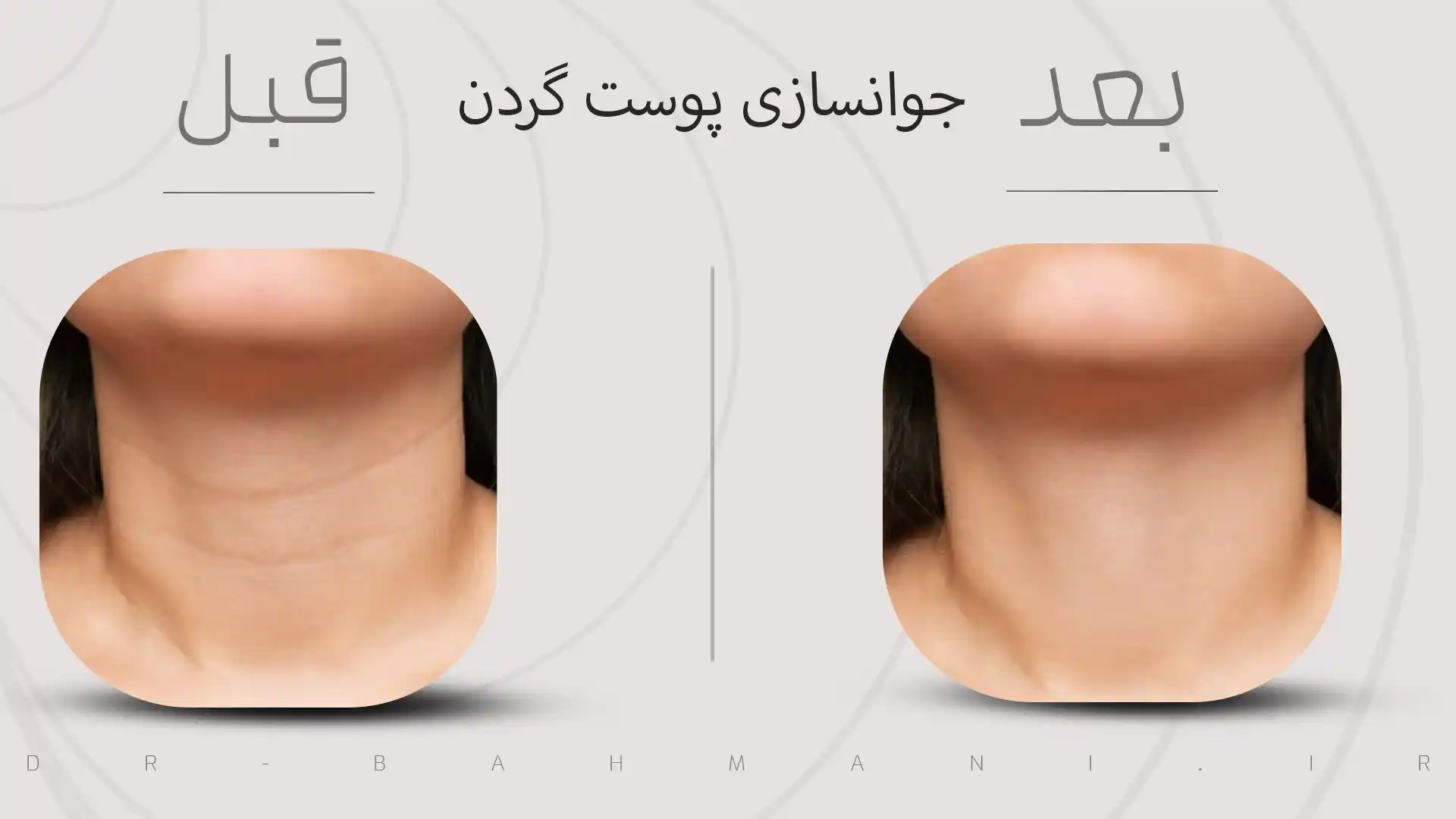 قبل و بعد جوانسازی پوست گردن