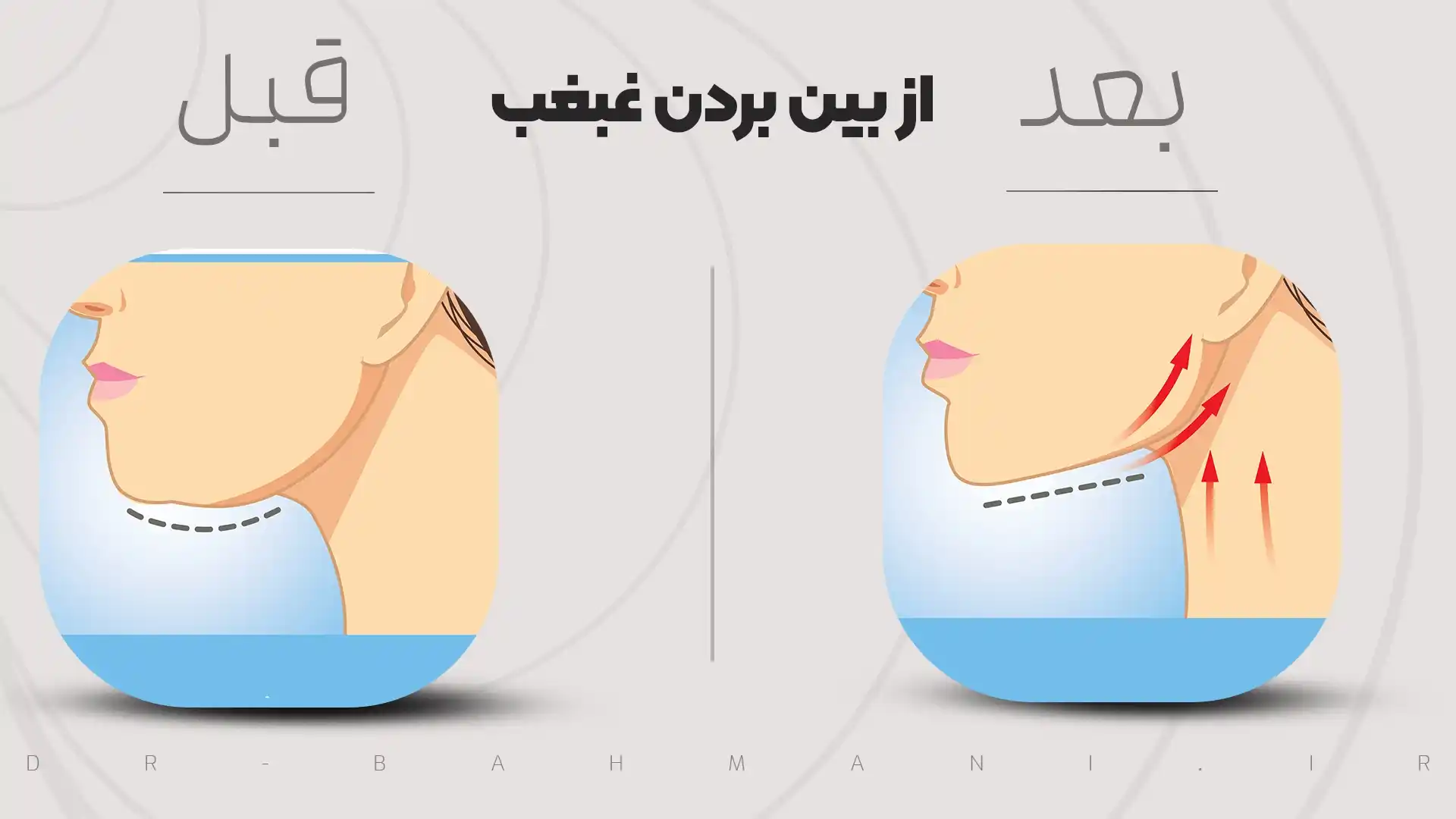 از بین بردن غبغب
