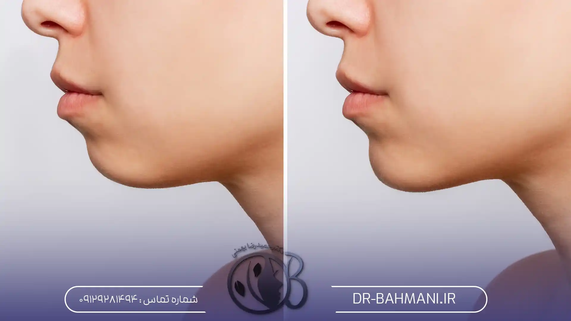 جراحی ژینوپلاستی