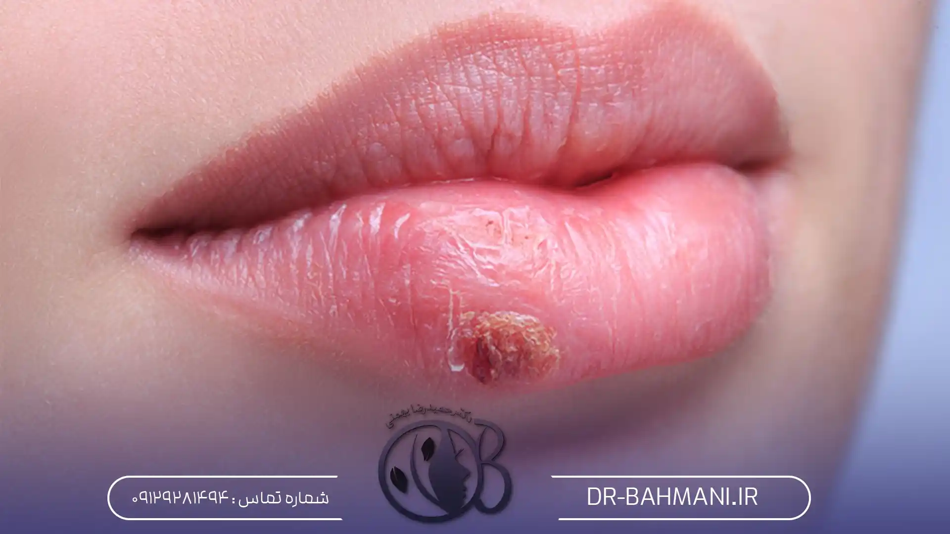 تبخال بعد از تزریق ژل لب