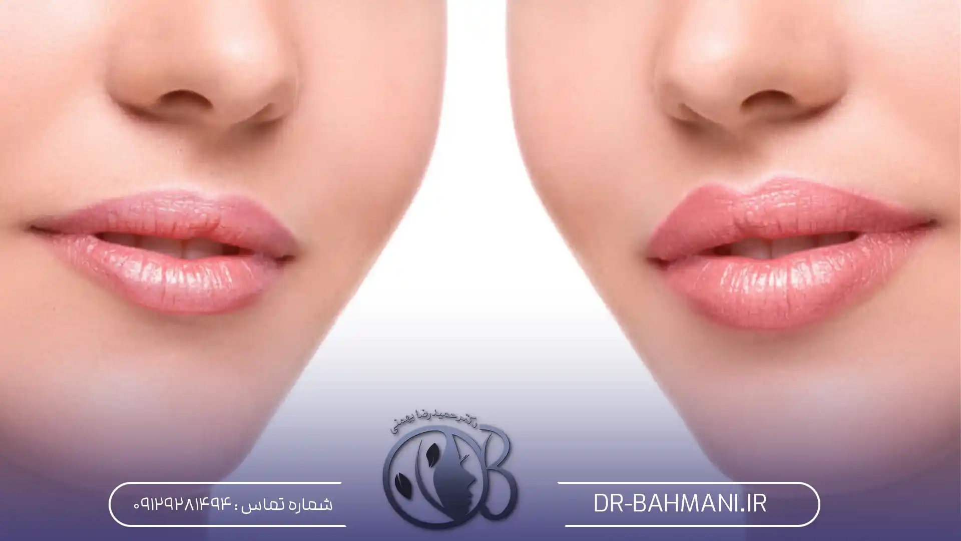 تزریق ژل لب برای لب های نازک
