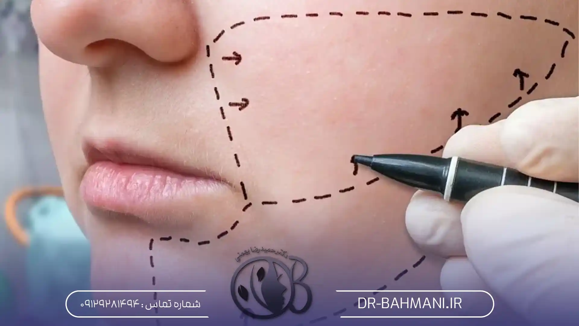 جراحی بوکال فت