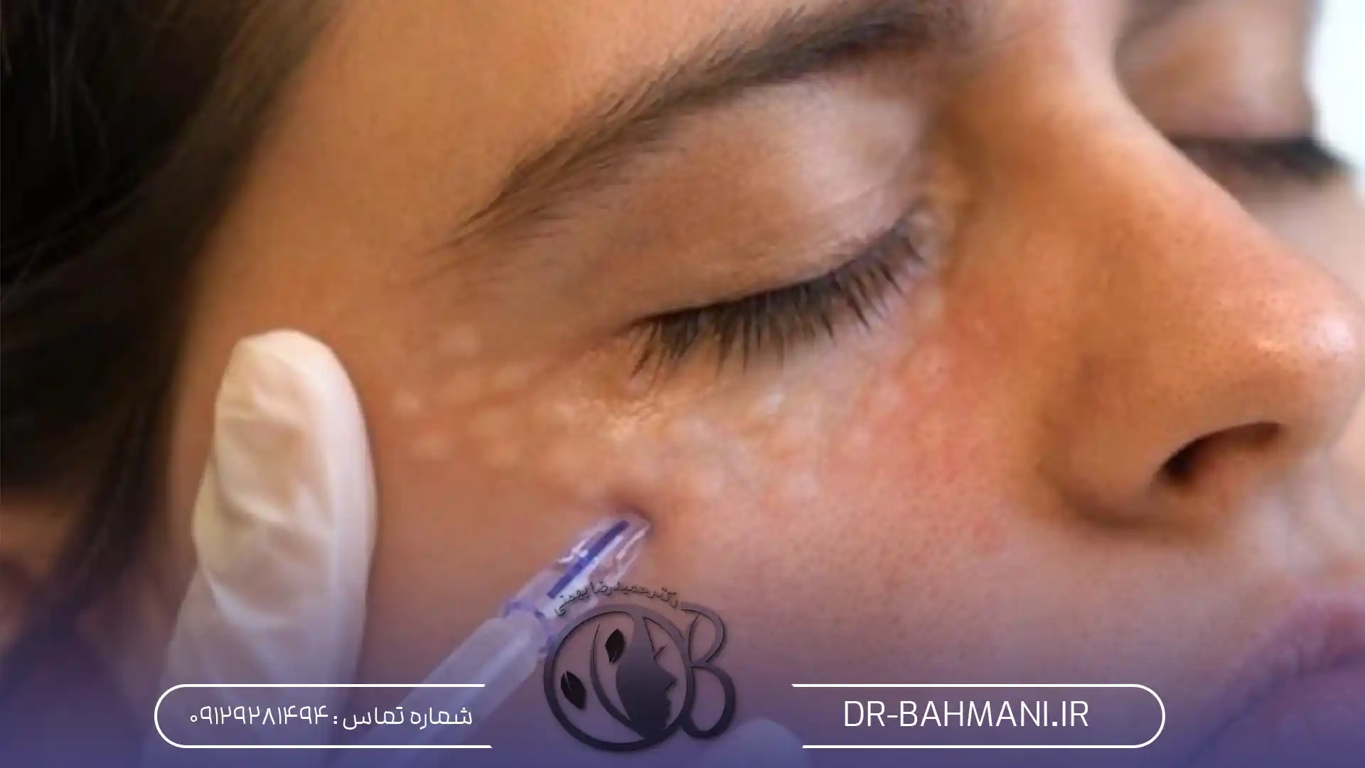 فرایند مزوتراپی دور چشم