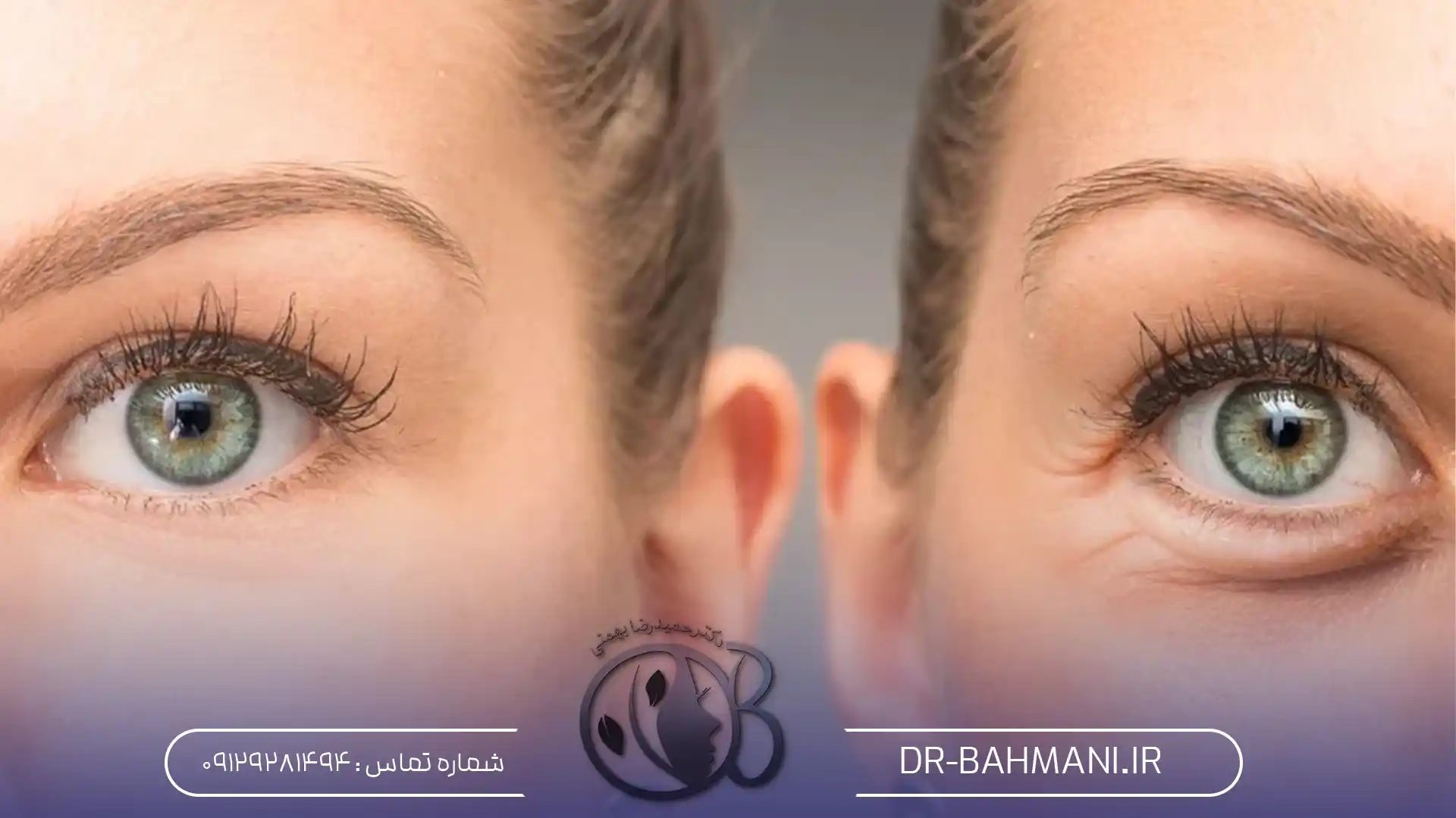 ماندگاری بوتاکس چشم گربه ای